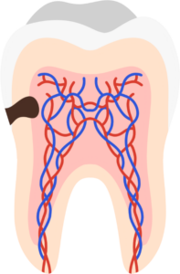 dental cavity on side
