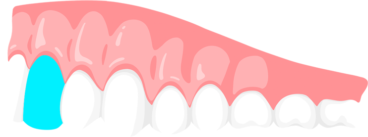 incisor teeth
