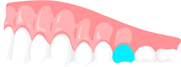 molar teeth