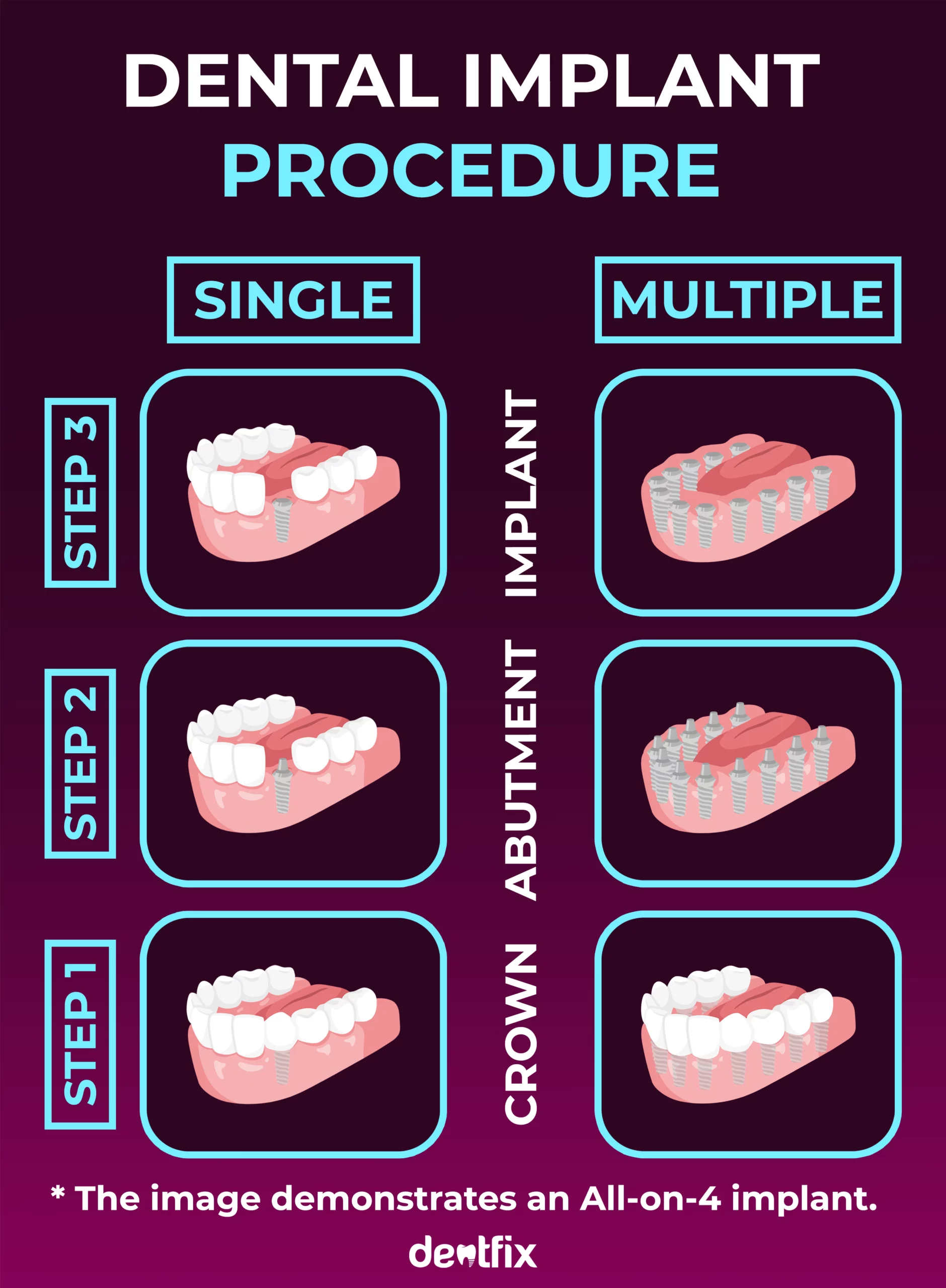 dental Implant Procedure